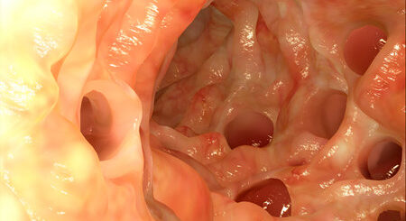 Cancer Colorectal Causes Symptômes Traitement Naturel